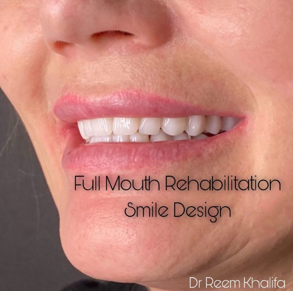 Full mouth rehabilitation and smile design result by Dr Reem Khalifa